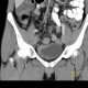 Crohn's disease of neoterminal ileum, abscess: CT - Computed tomography